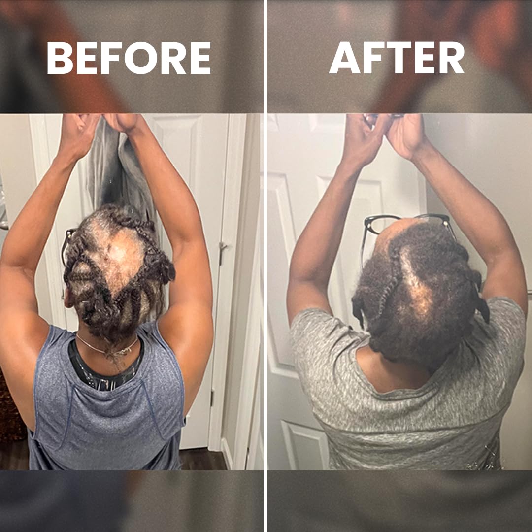 Rennora Hair Growth Serum with Organic Herbs and Natural Vitamins, Peppermint Oil, Stinging Nettle, and Rosemary Oil, No Chemicals, Formulated for Hair Regrowth (1 Pack - 30 Day Supply) - Image 8