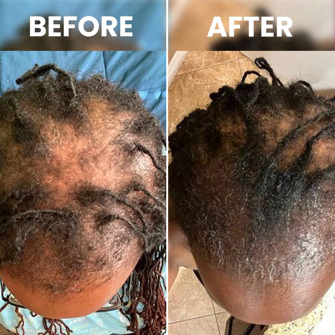 Rennora Hair Growth Serum with Organic Herbs and Natural Vitamins, Peppermint Oil, Stinging Nettle, and Rosemary Oil, No Chemicals, Formulated for Hair Regrowth (1 Pack - 30 Day Supply) - Image 9