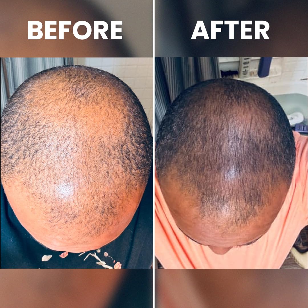 Rennora Hair Growth Serum with Organic Herbs and Natural Vitamins, Peppermint Oil, Stinging Nettle, and Rosemary Oil, No Chemicals, Formulated for Hair Regrowth (1 Pack - 30 Day Supply) - Image 7