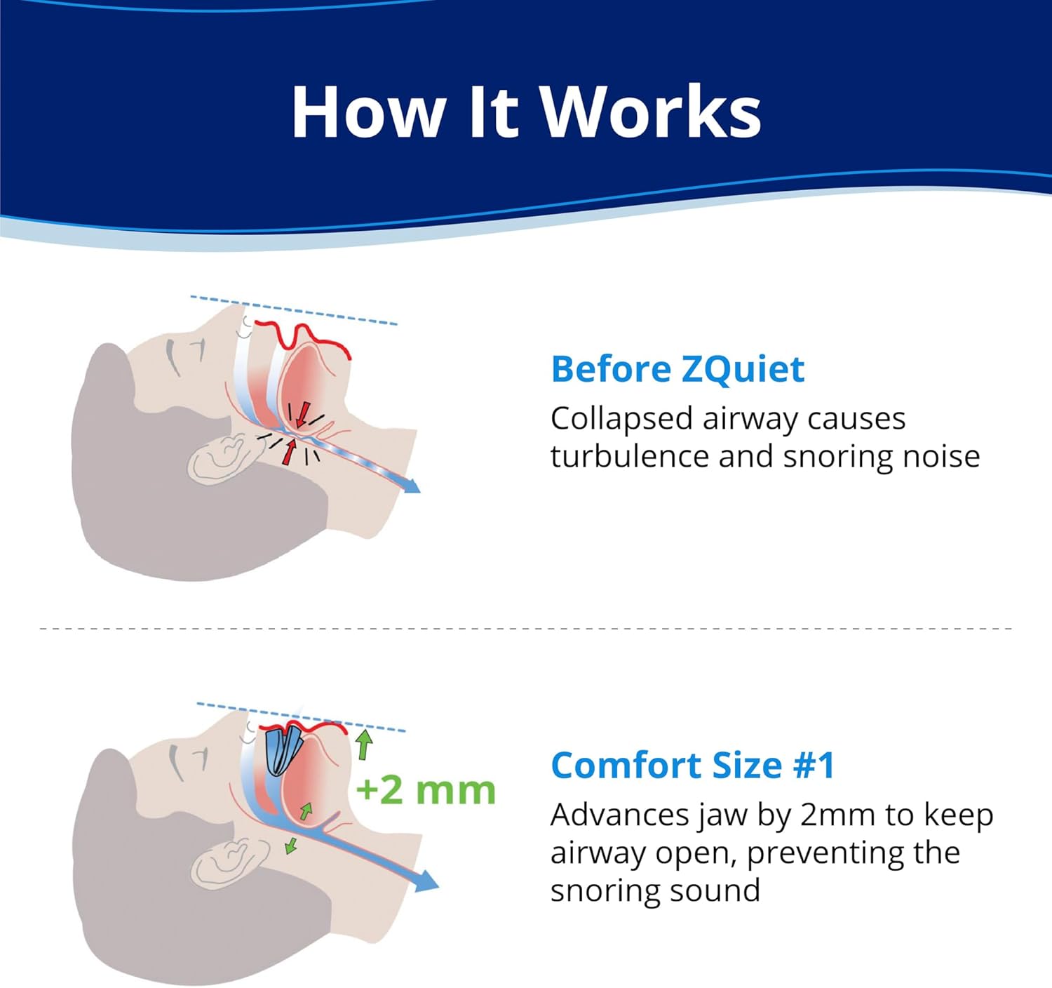 ZQuiet, Anti-Snoring Mouthpiece, Comfort Size #1, Single Refill, Blue, Made in USA, BPA-Free, Medical-Grade Material - Image 2
